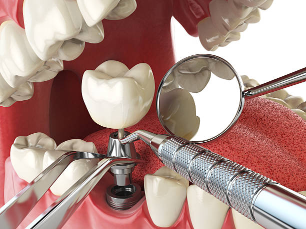 Best Emergency Wisdom Teeth Removal in West Carrollton, OH